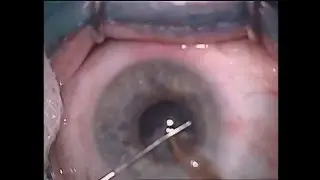 Операция на глаз ФЭК+ИОЛ  ПЭС+ миоз +сублюксация  lens+глаукома II b 21 05 15  21 мин