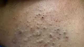 Deep Pore Cleansing and Blackhead Removal with Tweezers - Satisfying and Close-Up | Korean Skincare