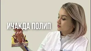ПОЛИП ИЧАКДА аниқланди | даволаш, операция