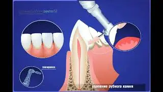 Чистка зубного камня и налета  полировкой профессиональной пастой.
