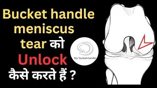 Bucket handle meniscus tear को Unlock कैसे करते हैं ? #drmanubora #meniscus