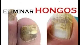 Como ELIMINAR los HONGOS en los PIES Remedios Caseros.