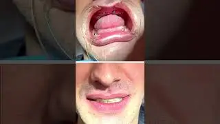 Dental prosthetics on implants