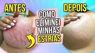 COMO ELIMINEI TODAS AS MINHAS ESTRIAS - ANDREZA FARIAS