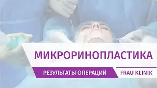 Результат микроринопластики - хирург доктор Абрамян