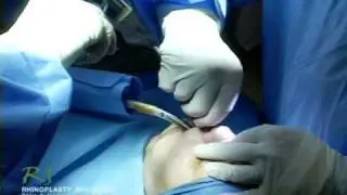 Dr. Nassif's Closed Rhinoplasty How To - Fracturing Nasal Bone