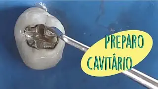 Preparo cavitário