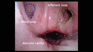 Early transanal closure after vacuum-assisted drainage for anastomotic leakage in rectal cancer