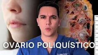 Cuando el acné resultó ser síndrome de ovario poliquístico | Dr. William Guerrero