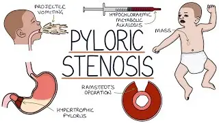 Understanding Pyloric Stenosis