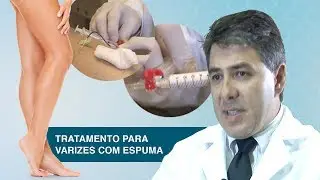 Tratamento para varizes com Espuma