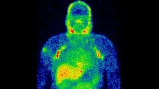 radiation testing on australians