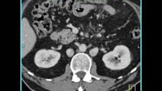 Duplication of IVC