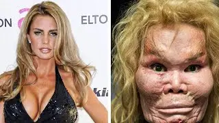 25 Desastres de Cirurgia Plástica em Famosos