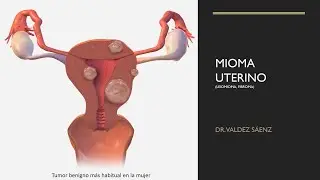 Mioma uterino (leiomioma, fibroma)