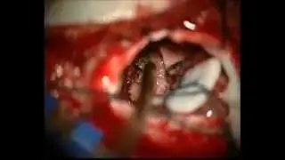 CPA meningioma right retrosigmoid approach by Prof Dr Selçuk YILMAZLAR