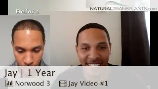 African American Male Hair Loss Treatment | Black Men Hair Growth Result (Jay)