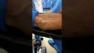 Visible pulsations of brachial artery