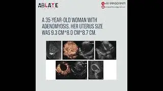 Fibroids ablation