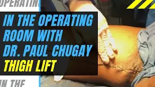 Thigh Lift Surgery - Body Sculpting, Reshape Thighs by Reducing Excess Skin