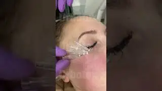Мезонити под глазами.
