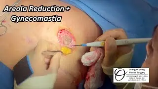 Areola Reduction + Gynecomastia | Orange County Plastic Surgery