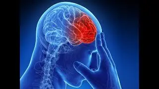 Stroke