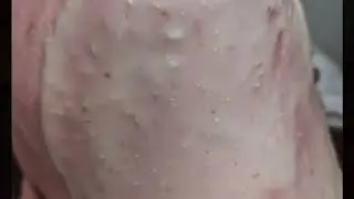 HYDROJELLY COMPLICATION VIDEO