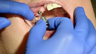 How we do it: 5 crowns for only 3 implants