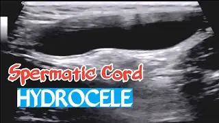 Ultrasound - Spermatic cord Hydrocele
