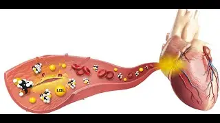 Hyperhomocysteinemia_Brief Overview_Dr Pradeep Rangappa
