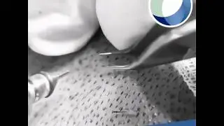💆‍♂️💆‍♀️ Implante Capilar FUE 👩‍⚕️👨‍⚕️