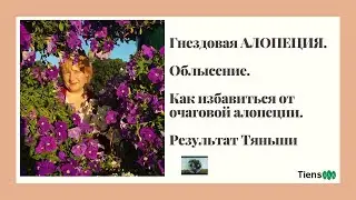 Гнездовая алопеция. Облысение.Как избавиться от очаговой алопеции.Результат Тиенс
