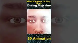 Inside the Migraine: Understanding the Physiology of a Migraine Attack