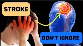 Having A BRAIN STROKE - Signs and Symptoms of BRAIN STROKE