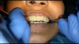 How to check bilateral contact in full mouth implant pateints?