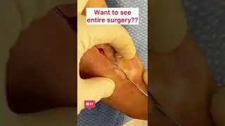 Draining pus from foot infection | 