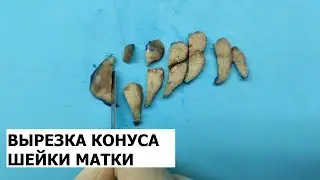 Конус шейки матки (конизация) - гистологическое исследование (вырезка).