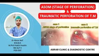 ASOM (stage of perforation) & Traumatic perforation of Tympanic membrane