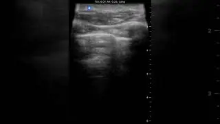 Lung Sliding | Clinical Image