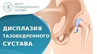 ❓ Что такое дисплазия тазобедренного сустава? Дисплазия тазобедренного сустава что это. 18+