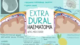 Extradural Haematoma Made Easy | Exam