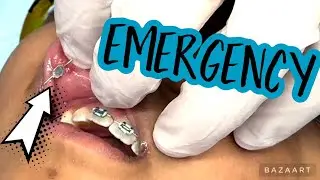 WE HAD AN EMERGENCY! 🆘 HIS BRACES GOT STUCK IN HIS LIP!