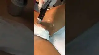 Epilazione laser alessandrine Barattolo