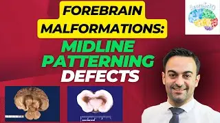Forebrain Malformation: Midline Patterning Defects