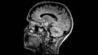 More than just a picture: Quantitative brain image analysis could positively impact MS patient care