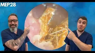 INFECTED EAR CANAL & ROCK HARD SKIN HUSK REMOVAL - MEP28