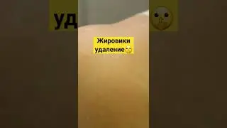 Жировики удаление причины возникновения #здоровье #здоровьеидолголетие #медицина #заздоровье