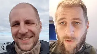 hair transplant istanbul before after 14 weeks