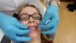 Getting My Braces Off